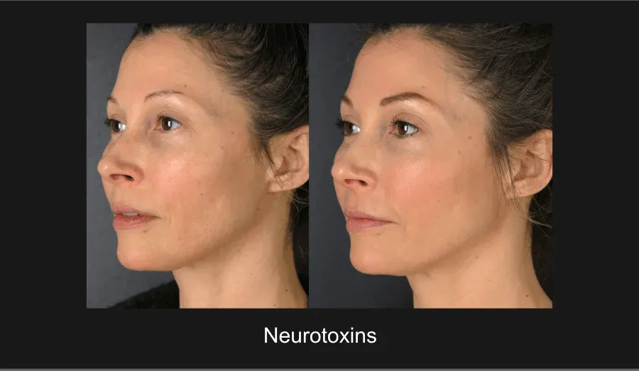 Xeomin Before & After