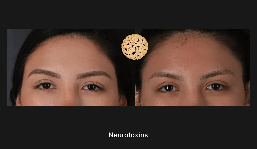 Xeomin Before & After
