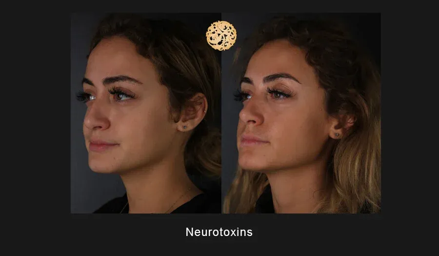 Xeomin Before & After