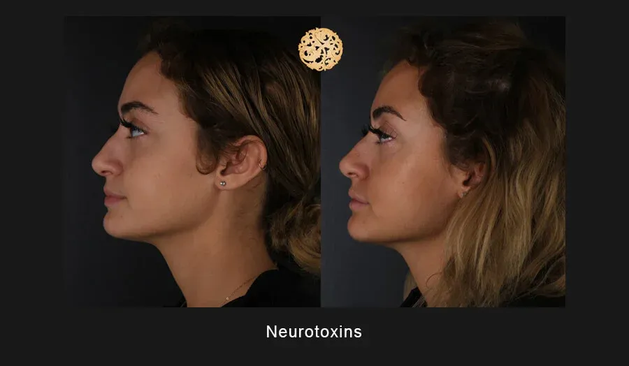 Xeomin Before & After