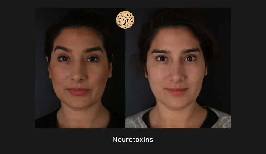 Xeomin Before & After