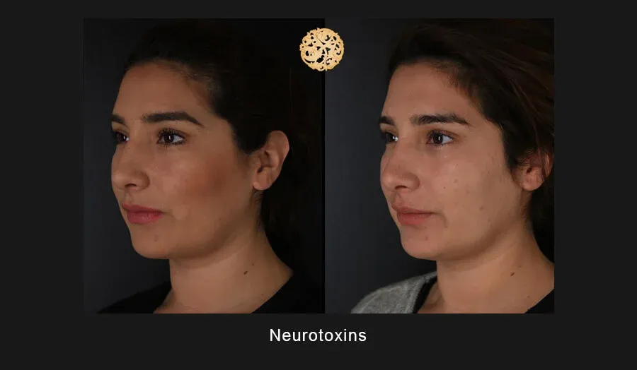 Xeomin Before & After
