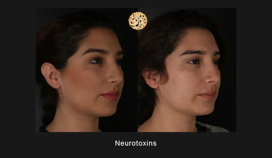 Xeomin Before & After