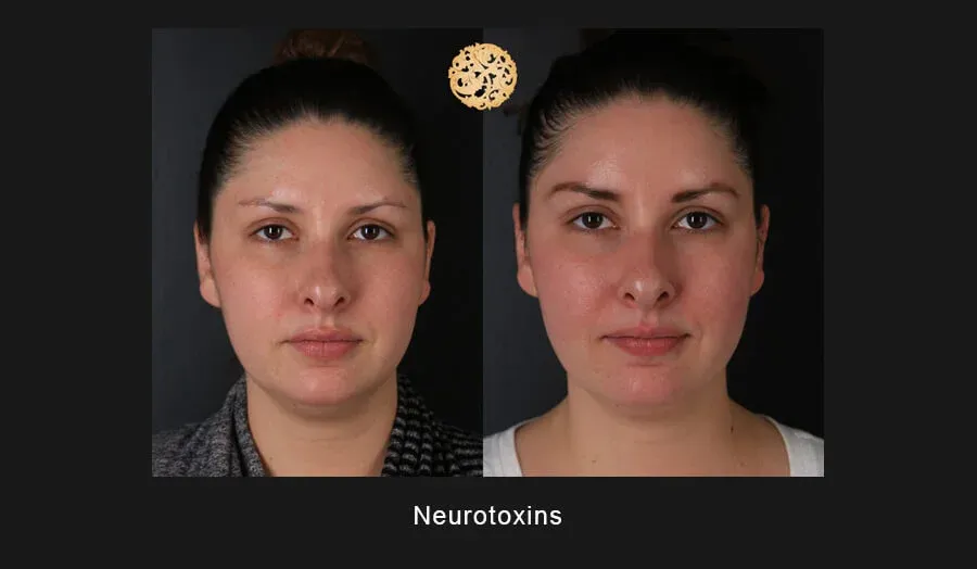 Xeomin Before & After