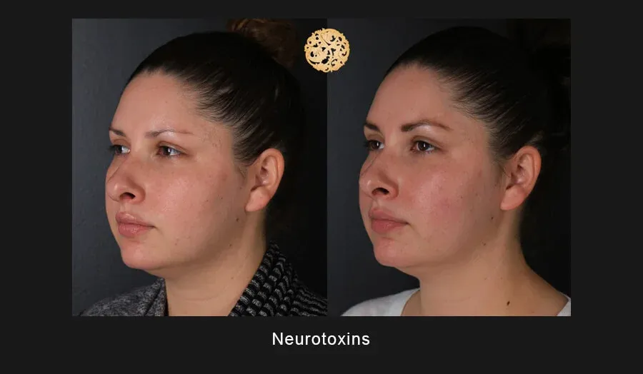 Xeomin Before & After