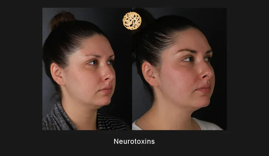 Xeomin Before & After