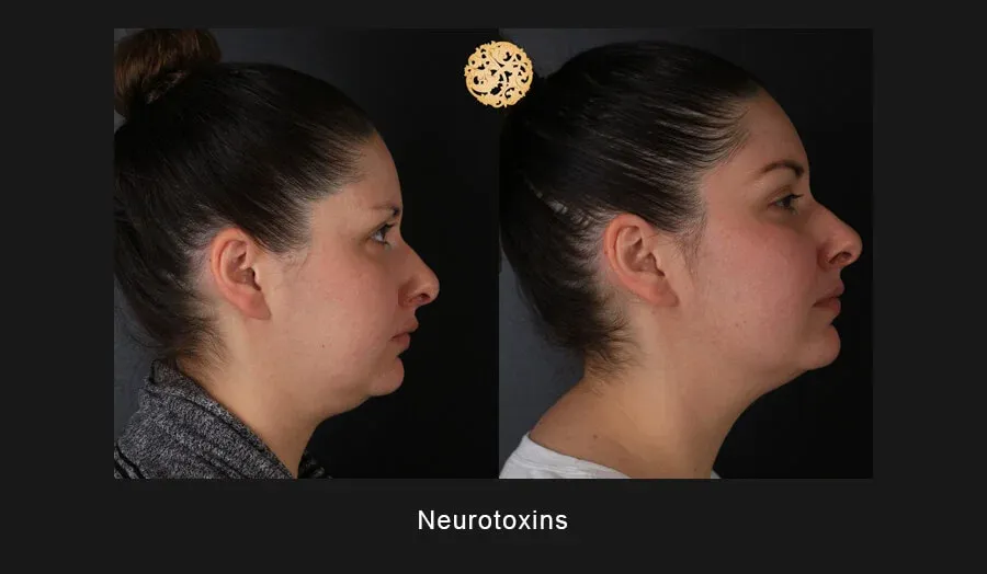 Xeomin Before & After