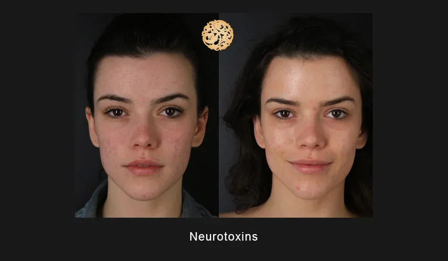 Xeomin Before & After