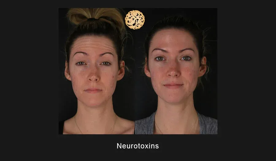 Xeomin Before & After