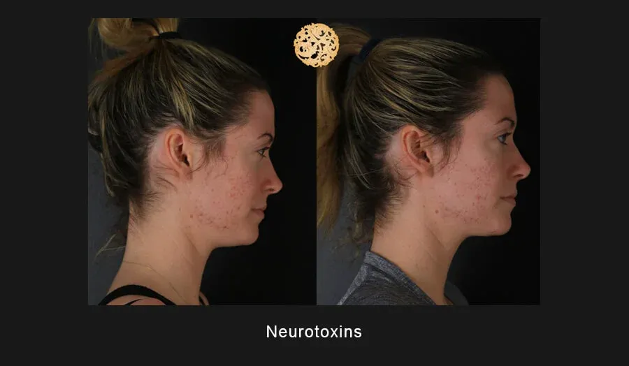 Xeomin Before & After