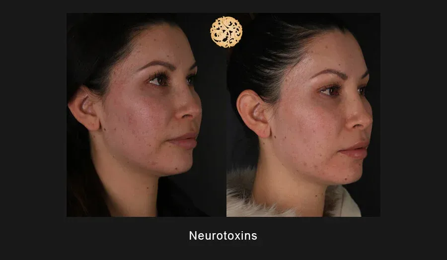 Xeomin Before & After