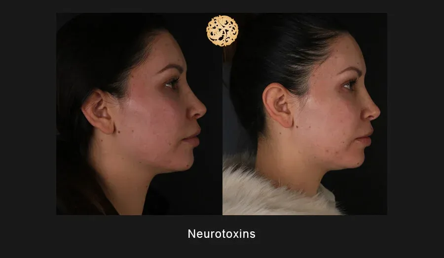 Xeomin Before & After
