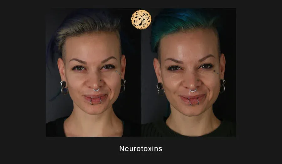 Xeomin Before & After