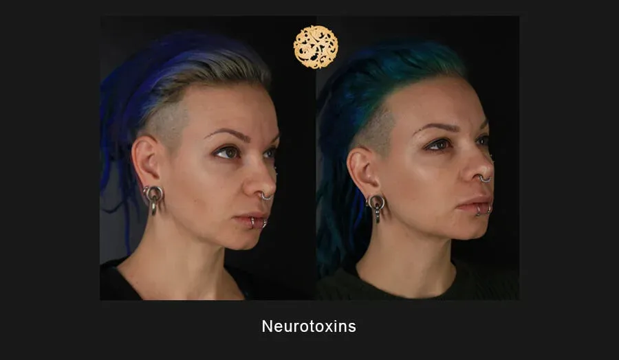 Xeomin Before & After