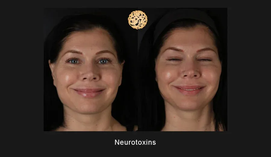 Xeomin Before & After