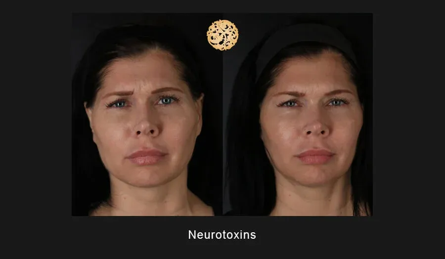 Xeomin Before & After