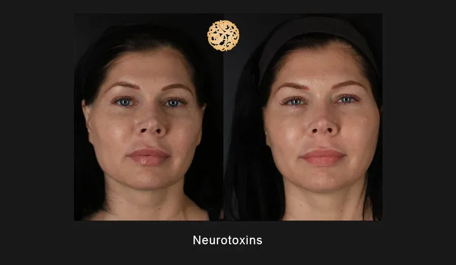 Xeomin Before & After