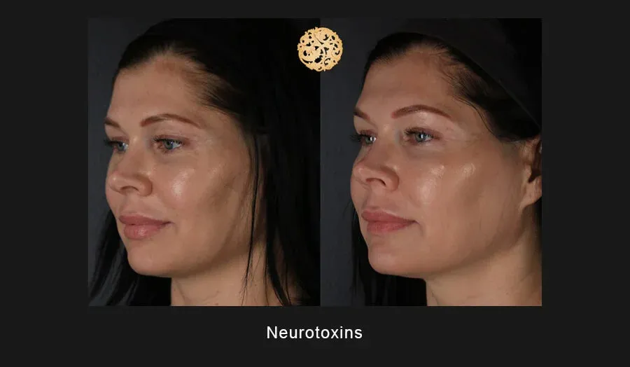 Xeomin Before & After