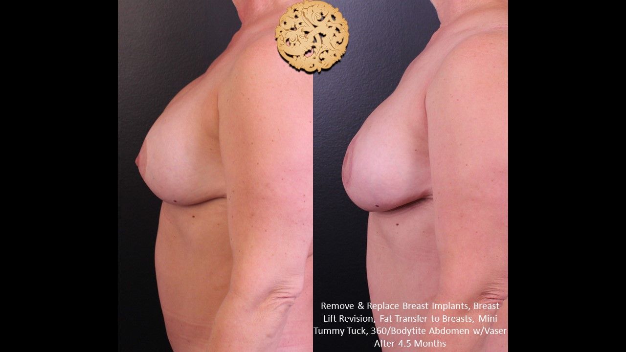 Breast Implant Exchange Before & After