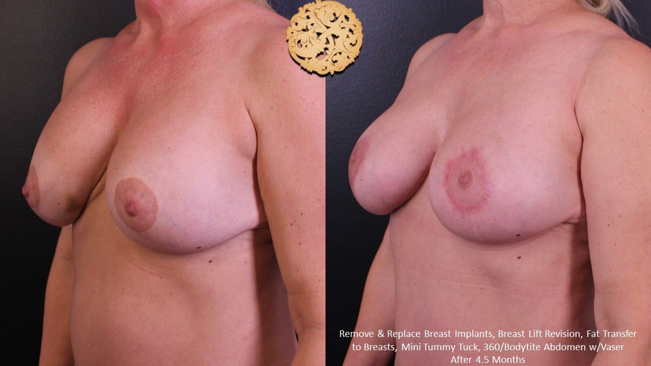 Breast Implant Exchange Before & After