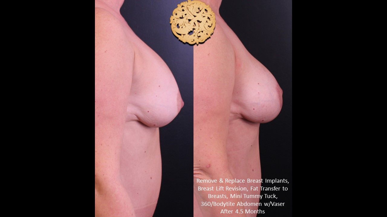 Breast Implant Exchange Before & After