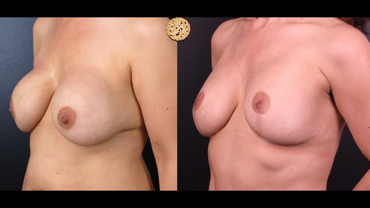 Breast Implant Exchange Before & After