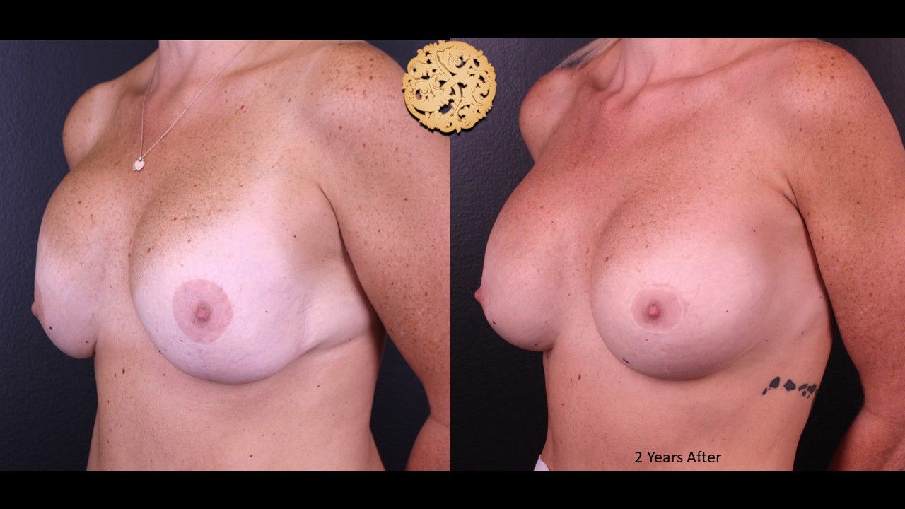 Breast Implant Exchange Before & After