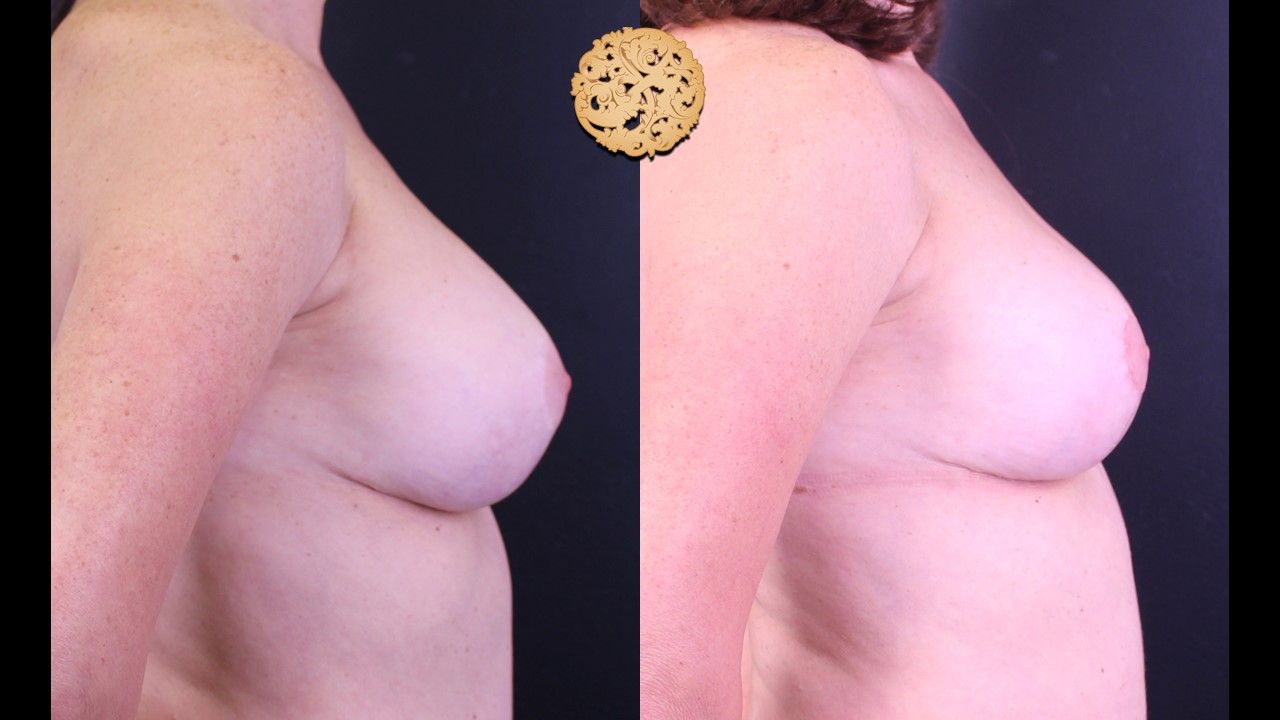 Breast Implant Exchange Before & After