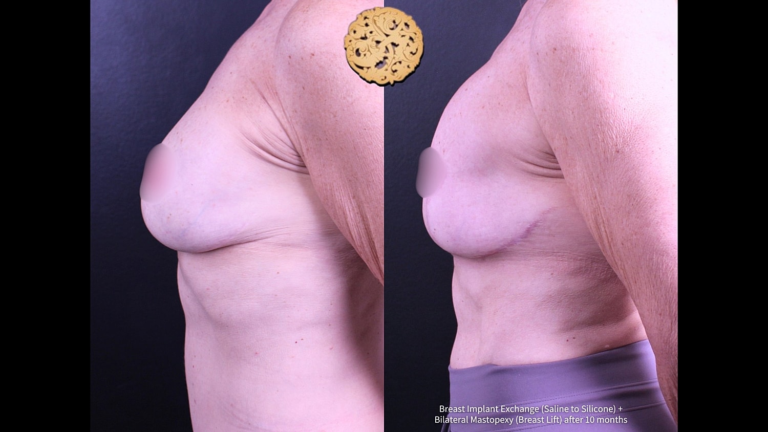 Before and after breast enhancement procedure comparison.