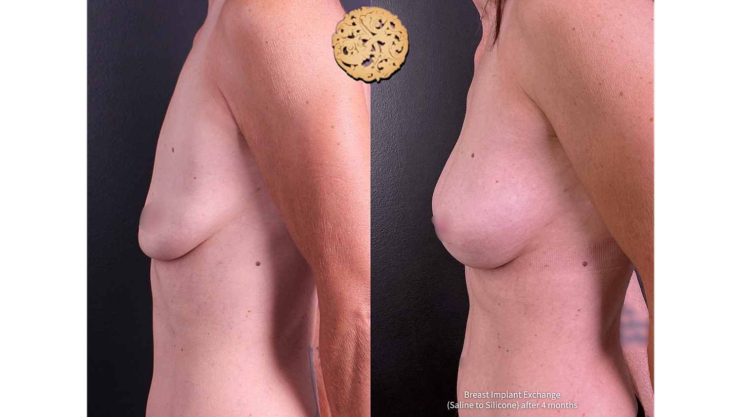 Breast implant exchange results, before and after.