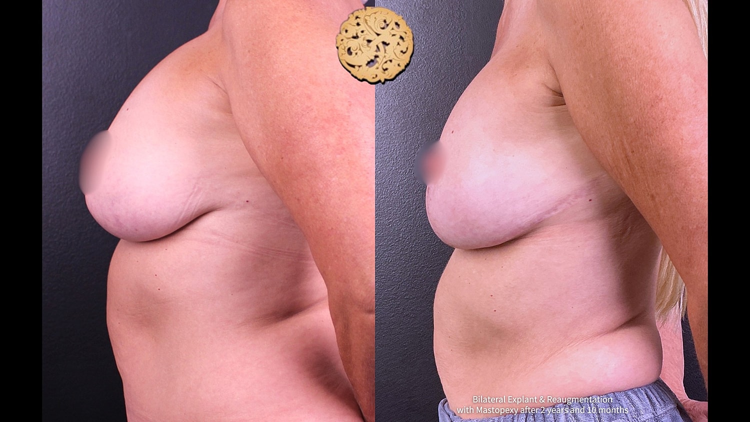 Breast Implant Exchange Before & After