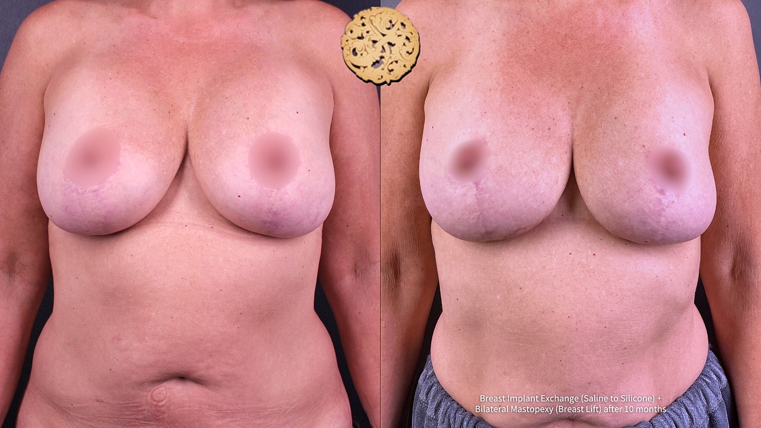 Breast Implant Exchange Before & After
