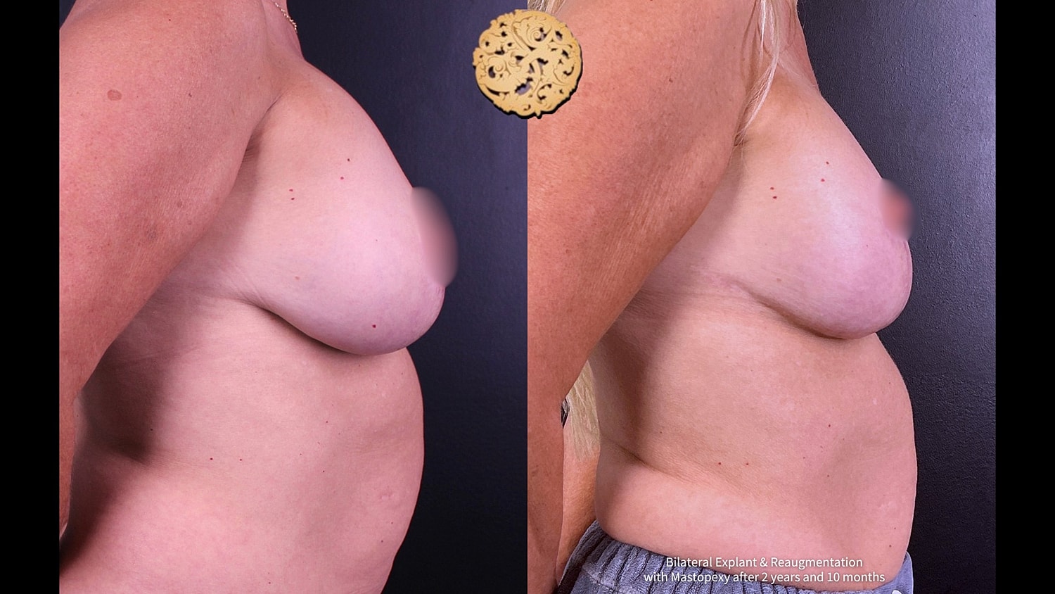 Breast Implant Exchange Before & After
