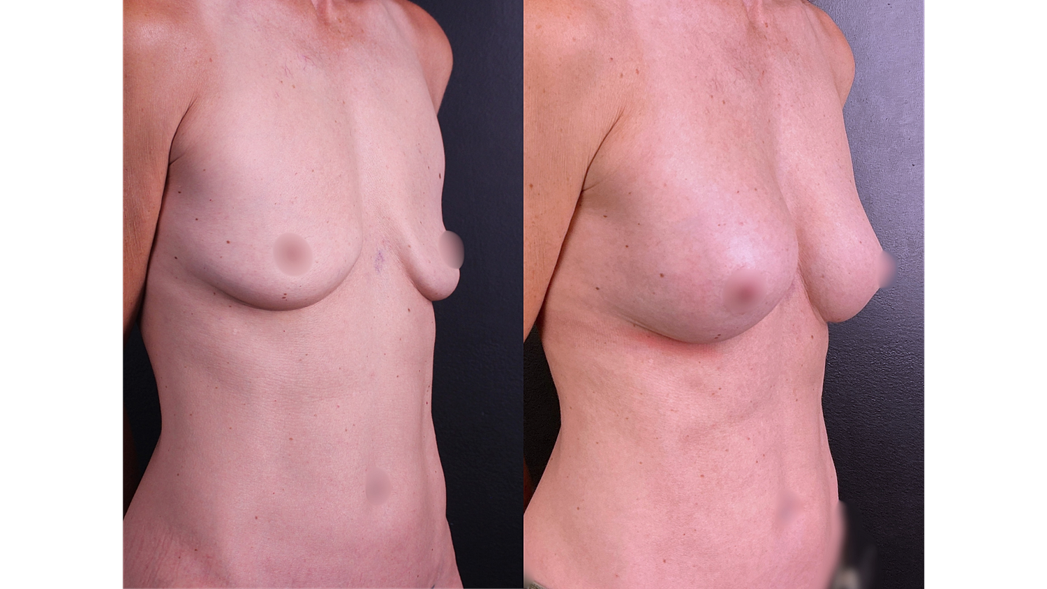 Before and after breast augmentation comparison image.