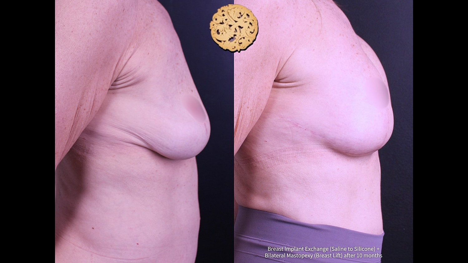 Before and after breast surgery comparison image.