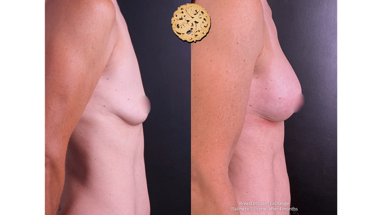 Breast implant exchange before and after comparison.