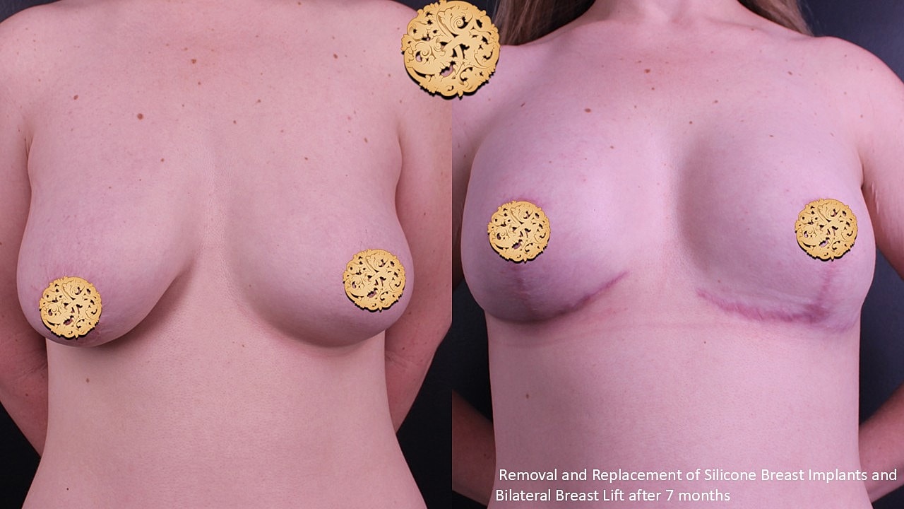 Before and after breast surgery comparison photo.
