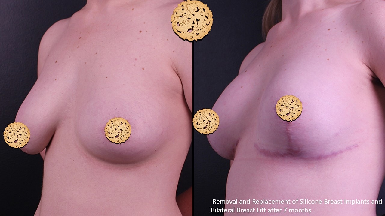 Breast implant surgery results before and after.