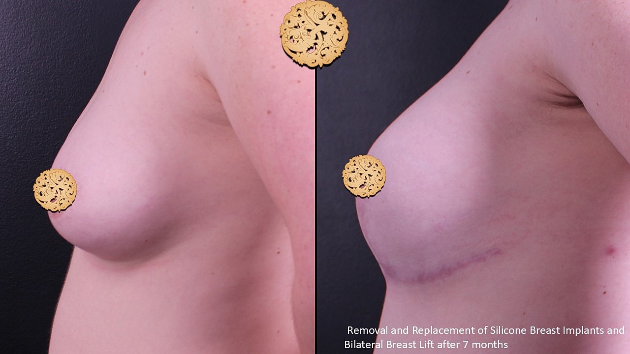 Before and after breast surgery comparison image