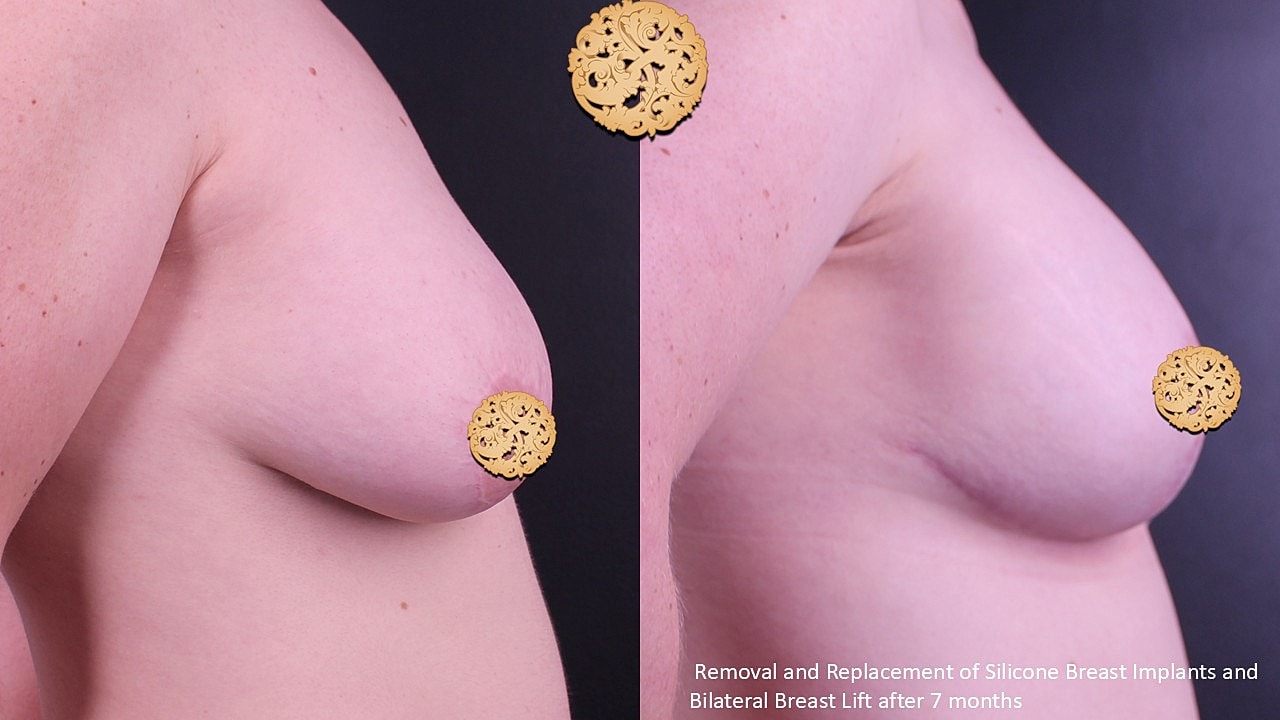 Breast implant removal and replacement results after surgery.