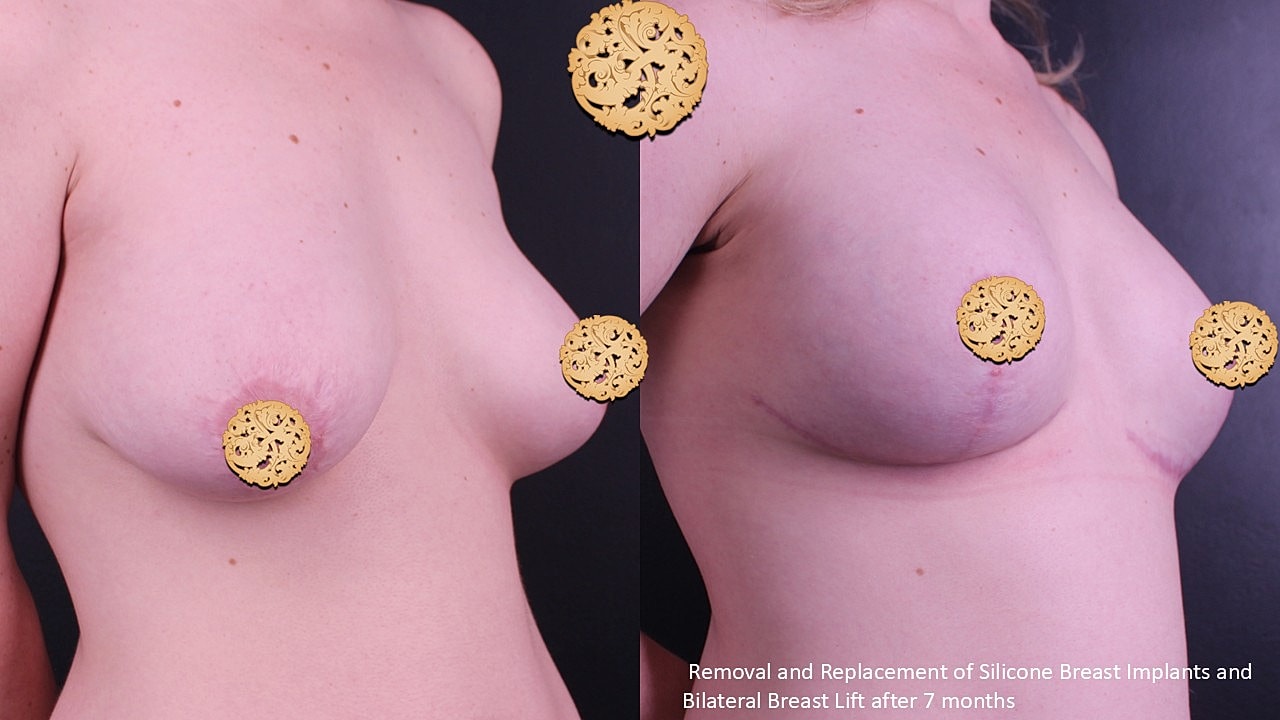 Before and after breast surgery comparison image.