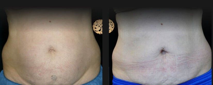 Coolsculpting Before & After
