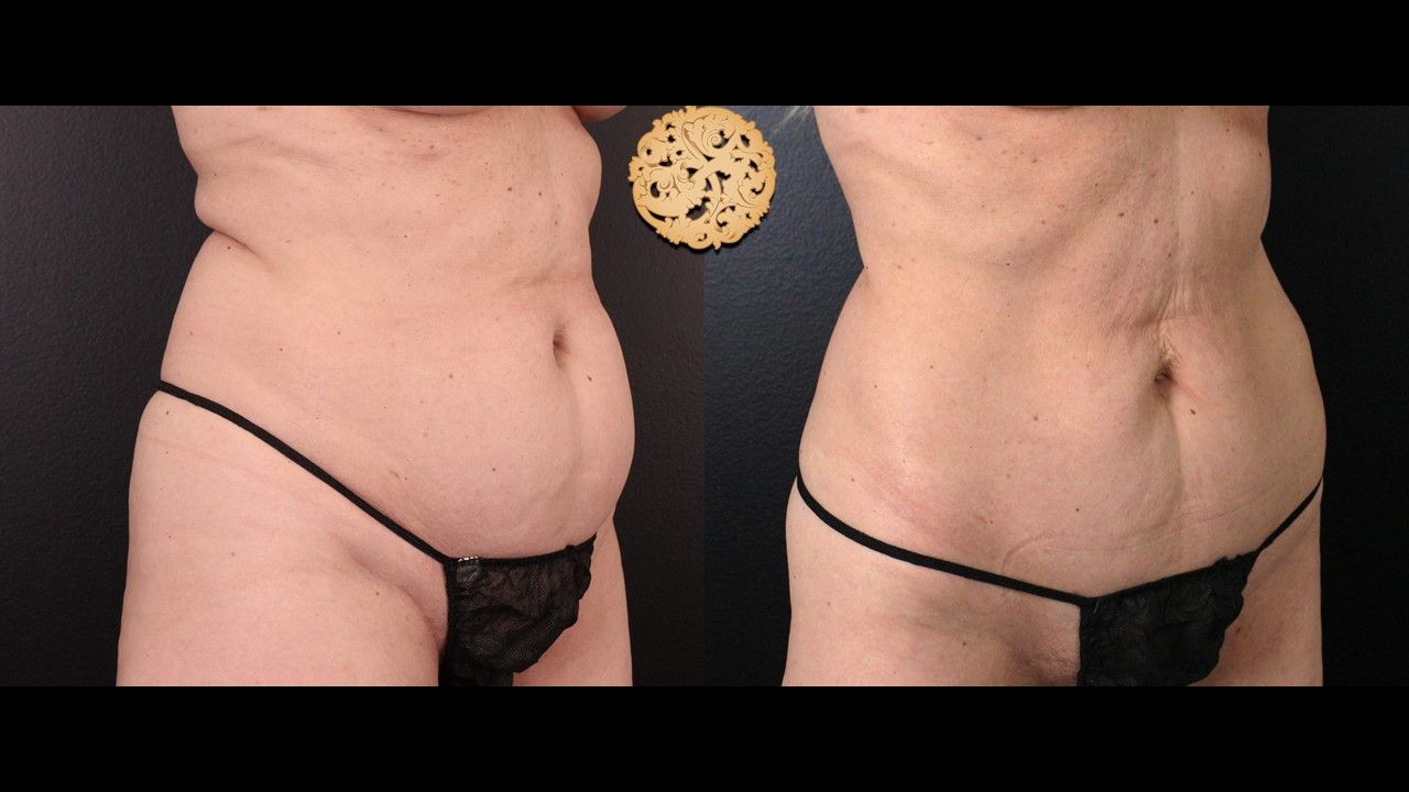 Coolsculpting Before & After