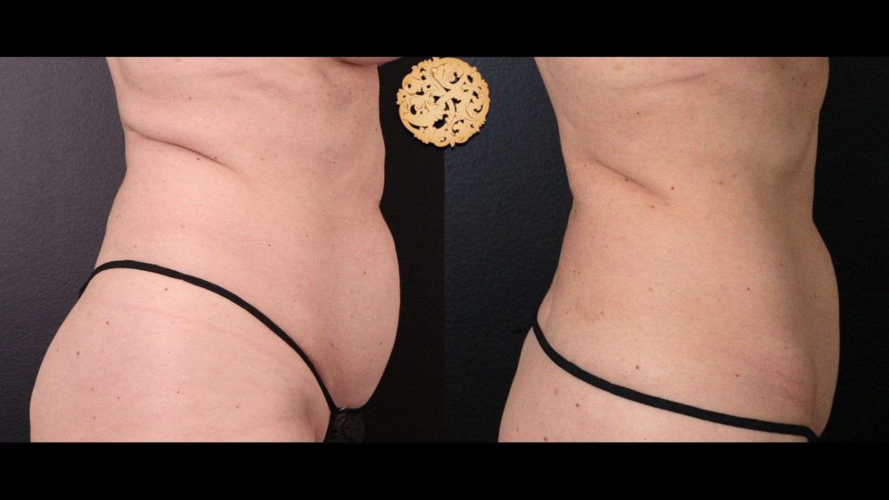 Coolsculpting Before & After