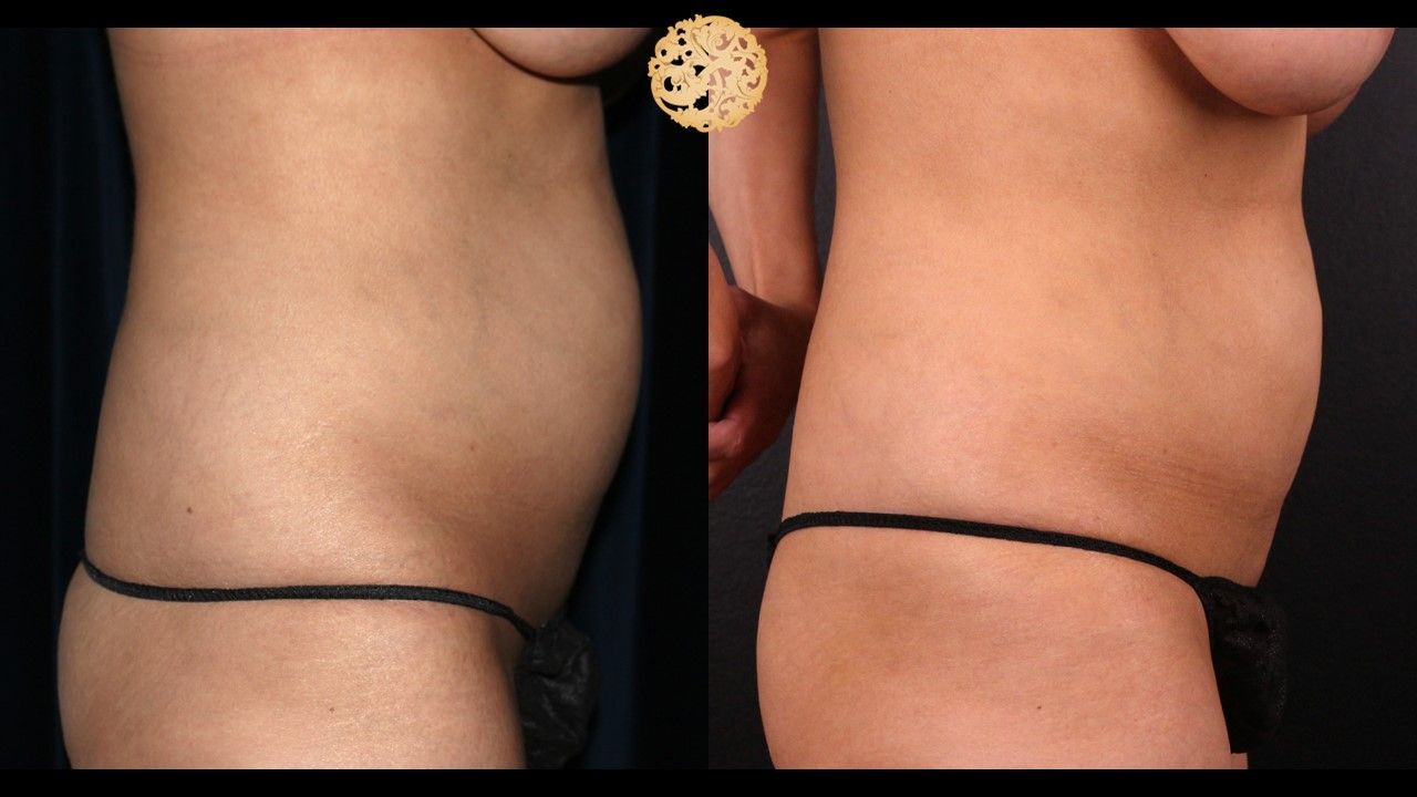 Coolsculpting Before & After