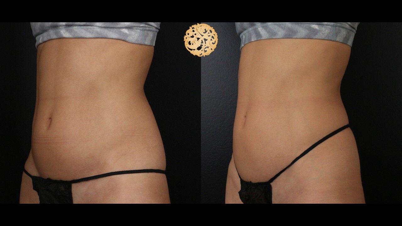 Coolsculpting Before & After