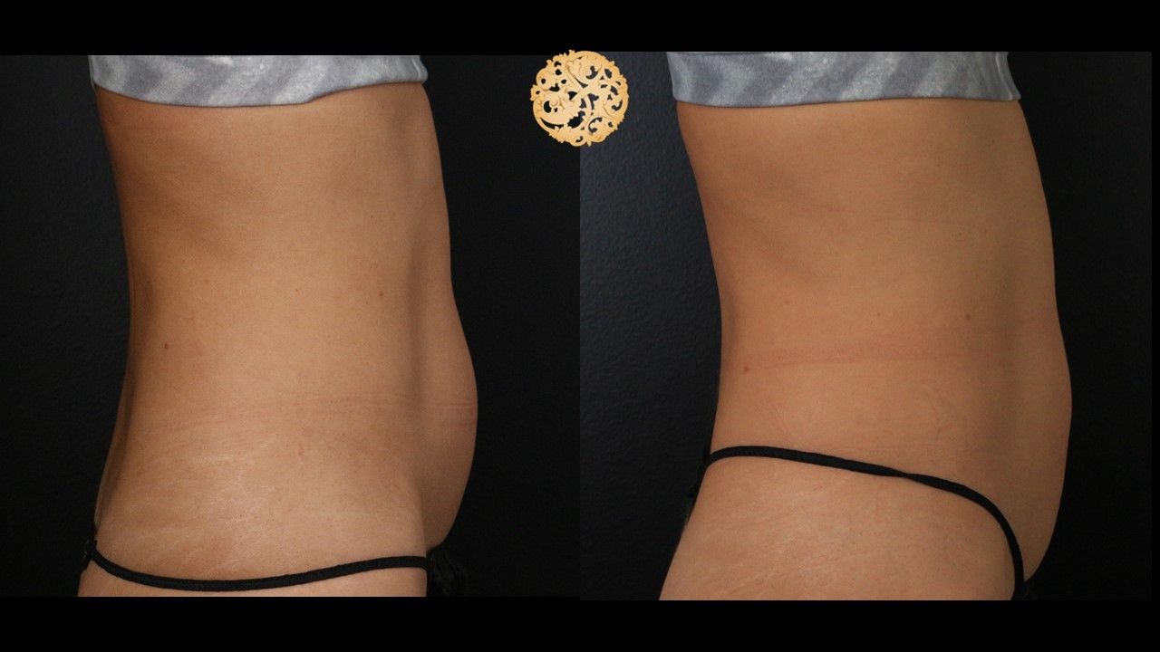 Coolsculpting Before & After