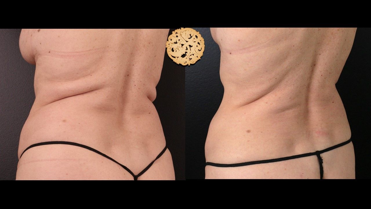 Coolsculpting Before & After