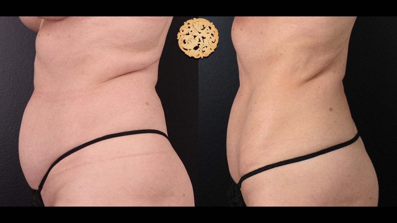 Coolsculpting Before & After