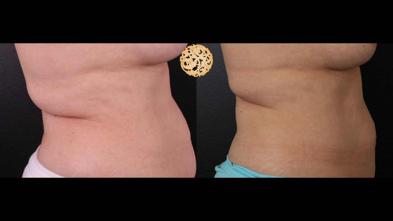 Coolsculpting Before & After